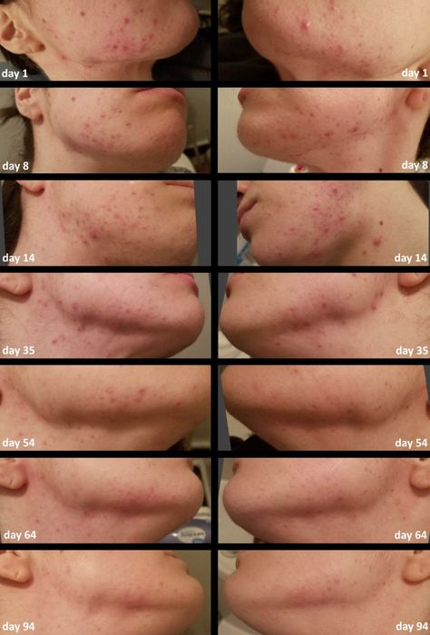 A series of progress images spanning 94 days, showcasing the noticeable improvement in the skin condition on a person's cheek and jawline.