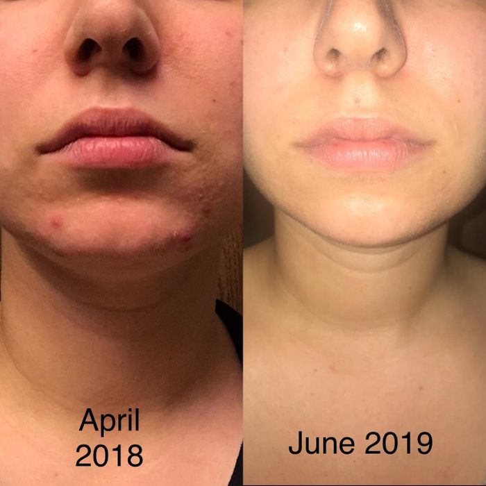 A reviewer's before-and-after images showing the results after using the La Roche-Posay medicated gel cleanser for over a year