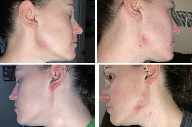 Reviewer on the right showing visible acne, with clearer skin on the left.