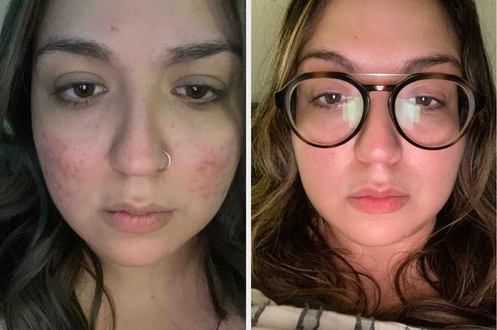A before-and-after image showcasing a person's face, with clearer skin likely due to a skincare product review or promotional content.