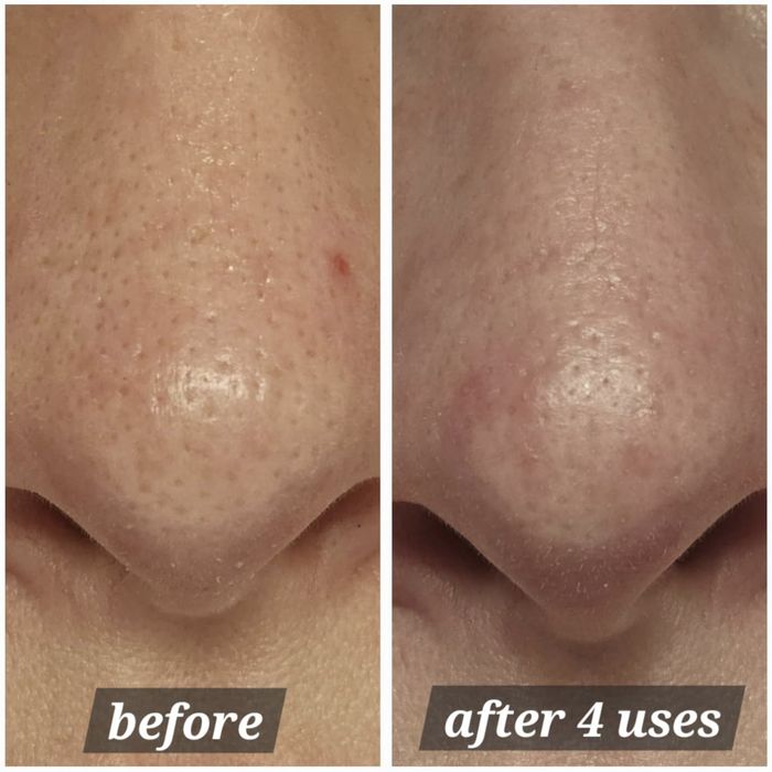 Close-up of a person's nose before and after using a skincare product.