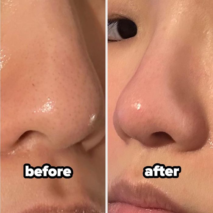 Close-up images of a person's nose shown side-by-side, each clearly labeled for comparison.