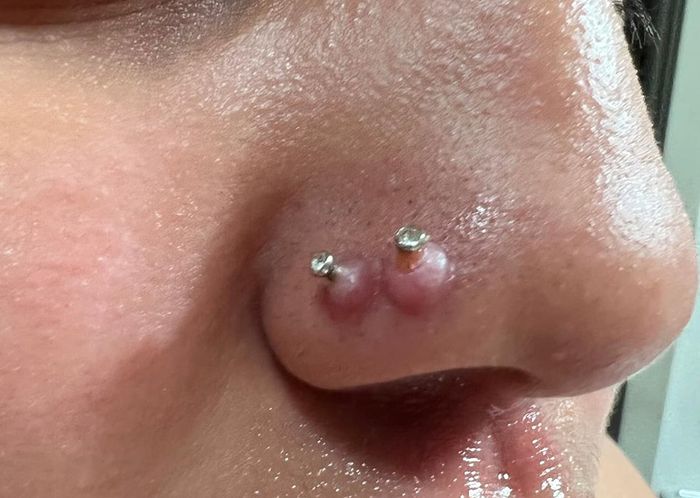 A close-up image of a reviewer's nose piercings, both affected by keloids.