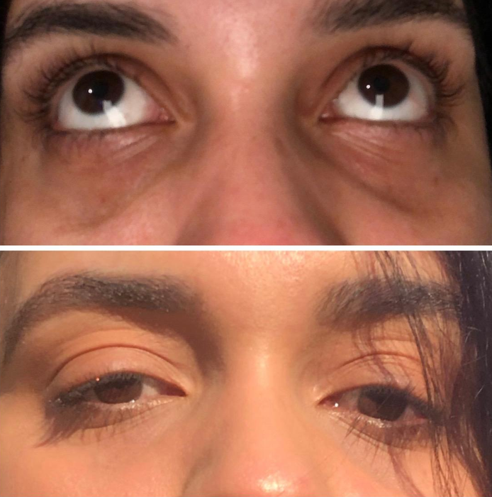 Before and after image showing the reviewer's under-eye area, with dark circles visibly diminished in the after photo