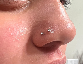The same reviewer's nose, now clear of keloids after using the solution.