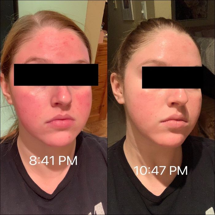 A before-and-after photo of a reviewer showing red skin on the left and noticeably less redness on the right after using the ointment.