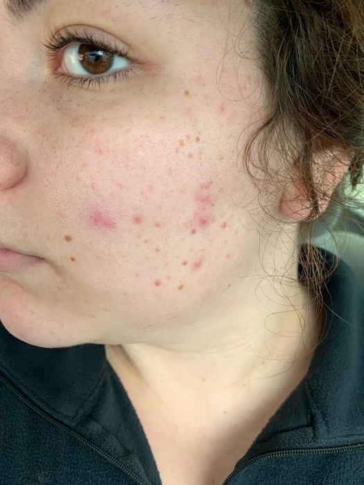 A reviewer's before photo showing visible redness and acne.