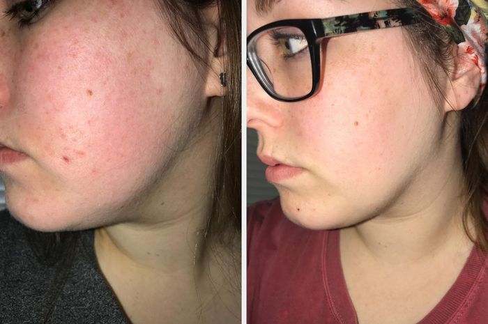 before/after showing the effects of the moisturizing cream on a reviewer, resulting in smoother skin with reduced redness