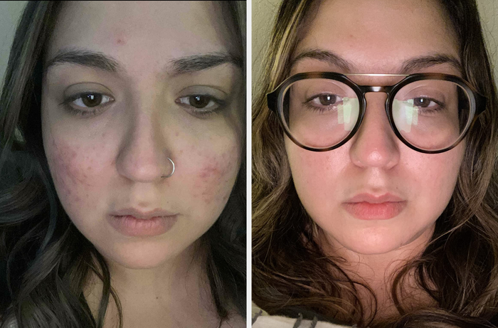 Before and after images demonstrating how the scrub balanced the reviewer's skin tone and cleared cheek breakouts.