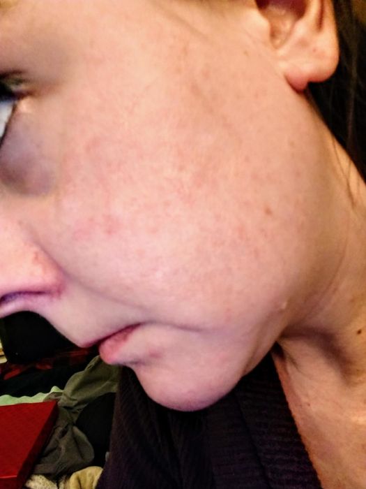Reviewer's transformation after using Vanicream Gentle Facial Cleanser