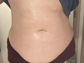 Close-up of a person's midsection where stretch marks appear visibly reduced after use