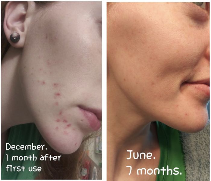 A comparison of skin before and after 7 months of using skincare products, showing visible improvement.