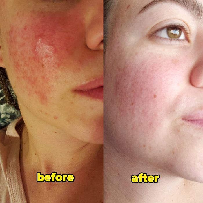 Reviewer showcasing an inflamed rosacea flare in a before photo, followed by a picture showing clear, calm skin after use
