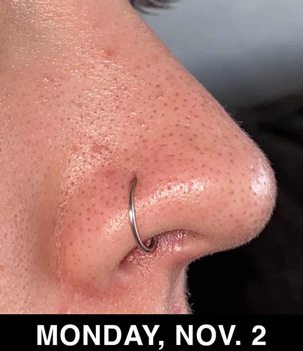 The reviewer before using the Paula's Choice BHA serum.