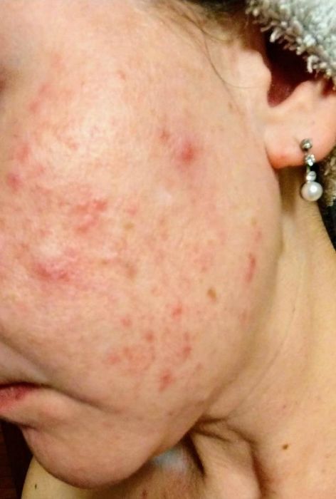 Reviewer's appearance before incorporating Vanicream Gentle Facial Cleanser into their routine