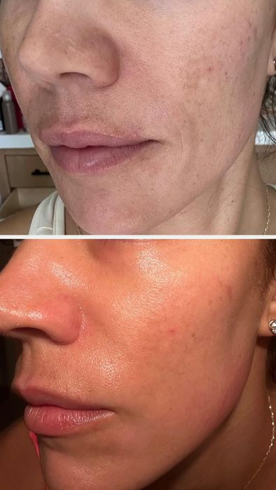 before/after showing brighter, more even skin after using the serum