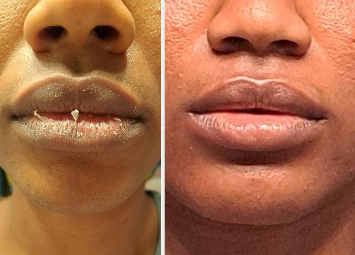 Before-and-after close-up of lips: left showing chapped skin, right looking smooth and hydrated.