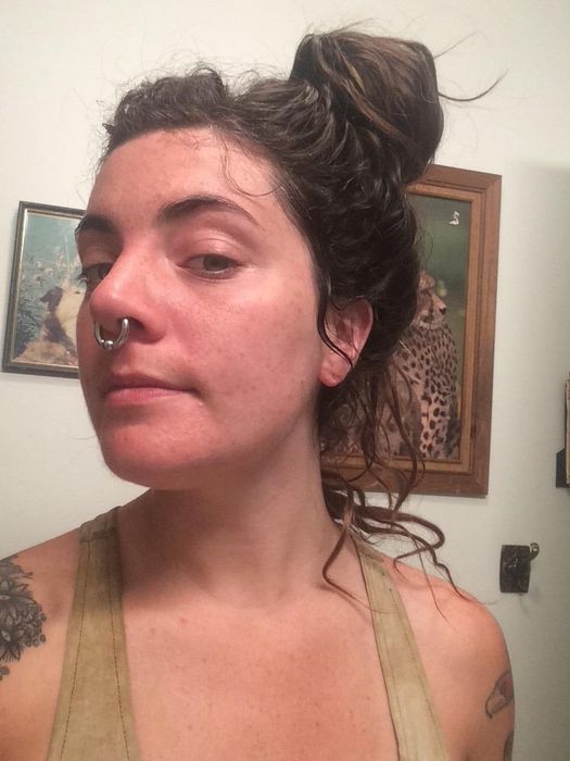 Reviewer's facial transformation after consistent use of Differin