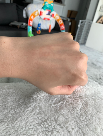 The same area of the hand after the rash has almost completely healed, showing significant improvement.