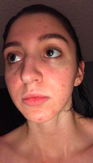 A reviewer experiencing acne breakouts on their face.