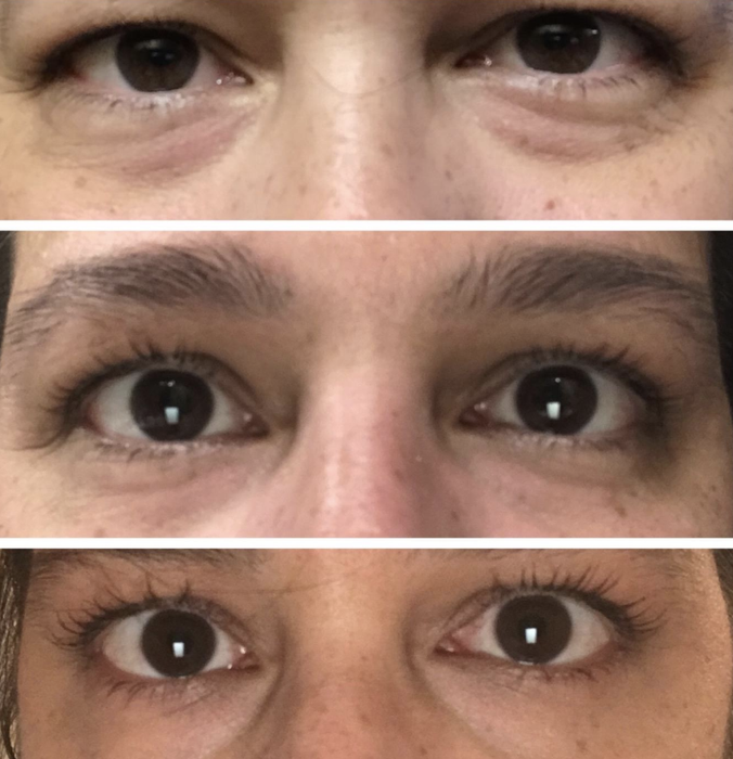 Users' before-and-after photos show noticeable smoothing of the under-eye area.