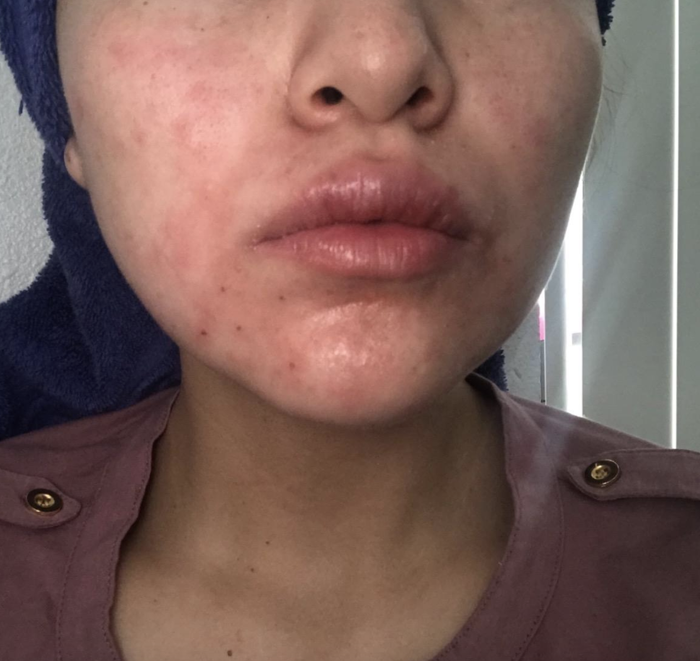 reviewer noticing redness around jawline