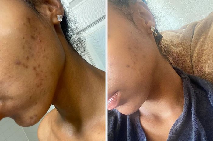 Before and after photos of a reviewer showing the reduction of acne scars after using the soap bar