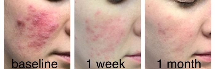 Three side-by-side images showing a reviewer’s irritated and red skin gradually becoming less red and smoother over the course of one month