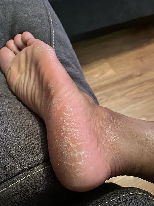 before image of the reviewer’s callused foot
