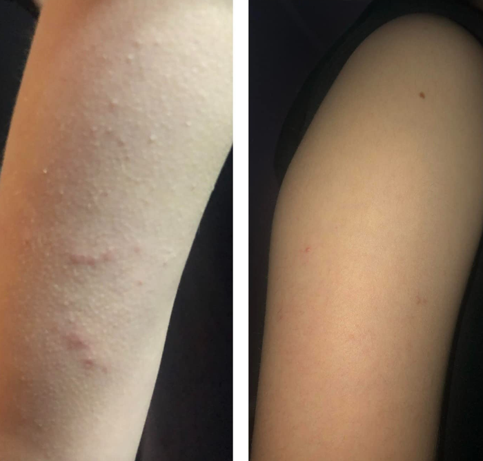 Before and after images demonstrate how the body wash completely cleared up the reviewer's arm bumps and breakouts