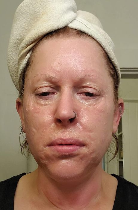 Reviewer wearing the mask, her skin visibly tightened