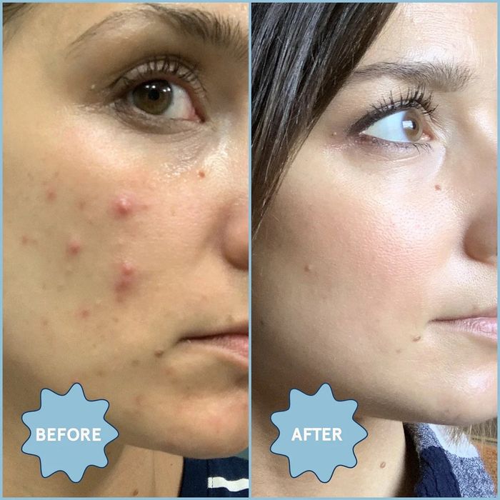 before and after images showing a model with acne on their face, followed by a clear complexion