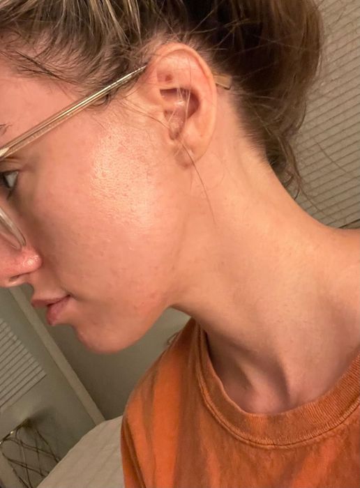 The same reviewer, four months later, with noticeably clearer skin