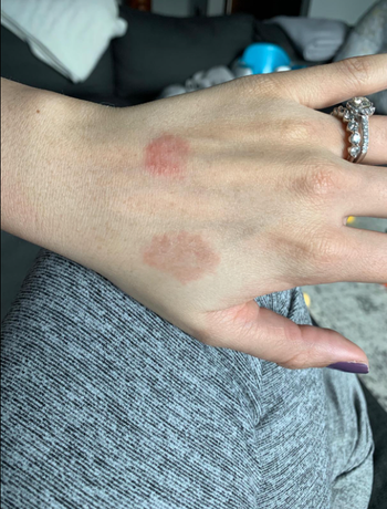 The back of the reviewer's hand showing two inflamed patches of rash, appearing quite painful.
