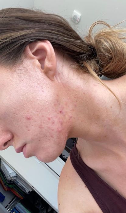 A reviewer showing acne on their chin and cheek before treatment