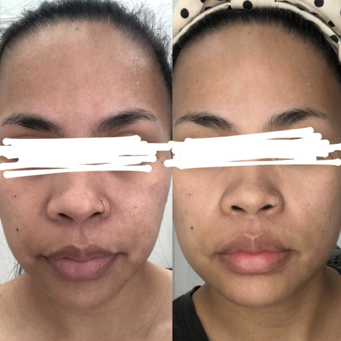reviewer showing visible scarring on the left with reduced scarring on the right