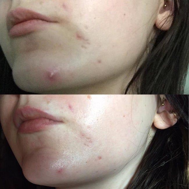 Above, reviewer with a large pimple on their chin. Below, the pimple visibly flattened