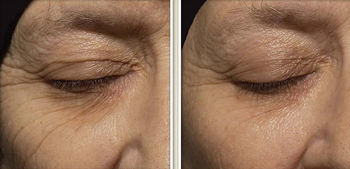 A model's eyes showing severe wrinkles initially, followed by a remarkable reduction in lines after three months
