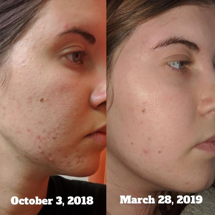 A reviewer showing their before-and-after: a broken-out cheek followed by a clear cheek in less than six months
