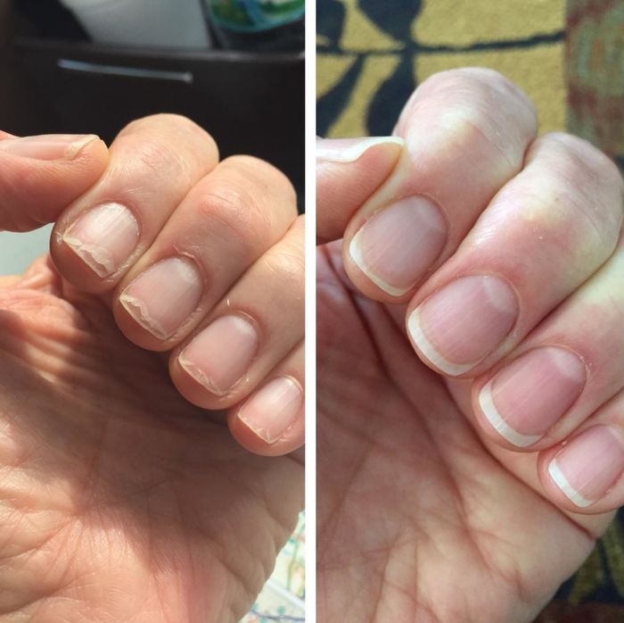 Here’s a before-and-after of a reviewer who used the oil, showcasing a noticeable reduction in nail breakage.