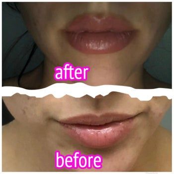 A reviewer's lips before and after using the lip plumper.