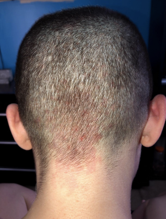 A reviewer with a buzz cut and visible skin irritation underneath the hair