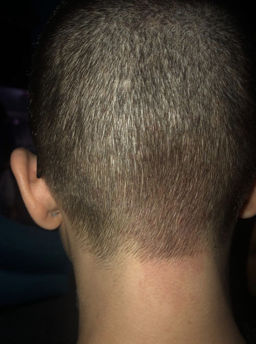 The same reviewer’s scalp without any visible skin irritation