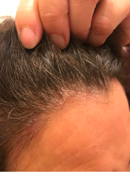 A reviewer with a hairline covered in numerous white dandruff flakes