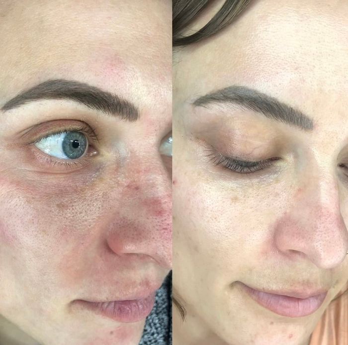 Before-and-after photos showing the reviewer’s skin transitioning from red and irritated to looking brighter and more hydrated.