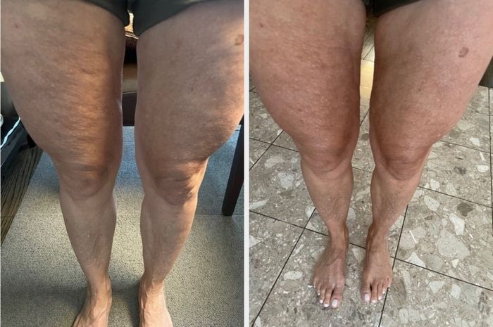 A before-and-after comparison from a reviewer showing noticeable improvements in the appearance of smoother and firmer skin on their legs.