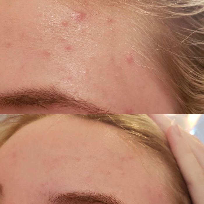 A reviewer's before and after photos showcasing the results of using the acne patch.