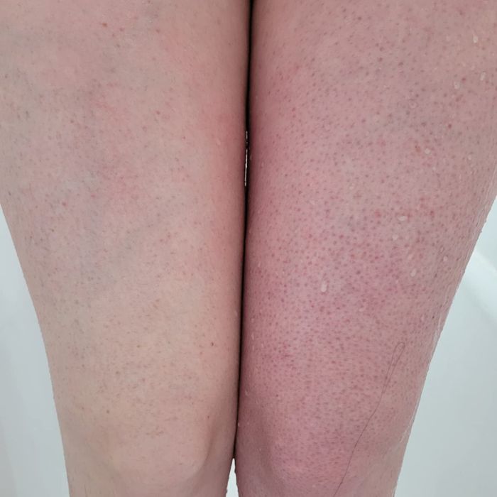 The reviewer's legs, one side showing visible bumps and the other side appearing much smoother after using the mitt.