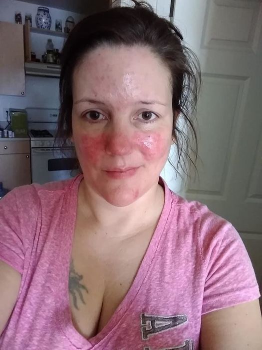A reviewer experiencing a rosacea flare-up on their face.