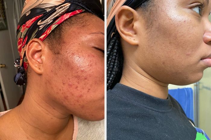 A reviewer's before-and-after showing skin that was red and acne-prone, followed by a noticeable improvement with clear, less-red skin.